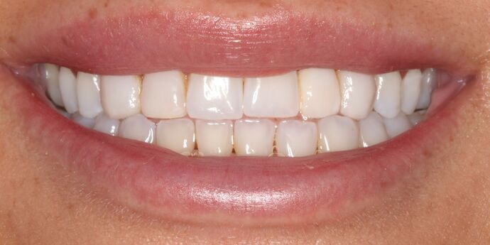 Smile Makeover: BreAnn - Before