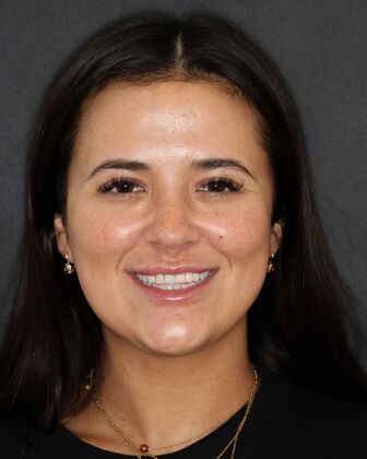 Smile Makeover BreAnn - Before