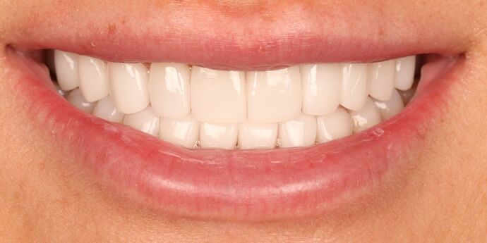 Smile Makeover: BreAnn - After