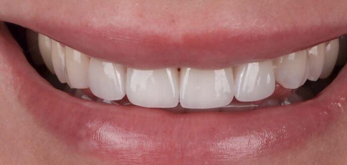 Smile Makeover & Veneers: Georgina - After