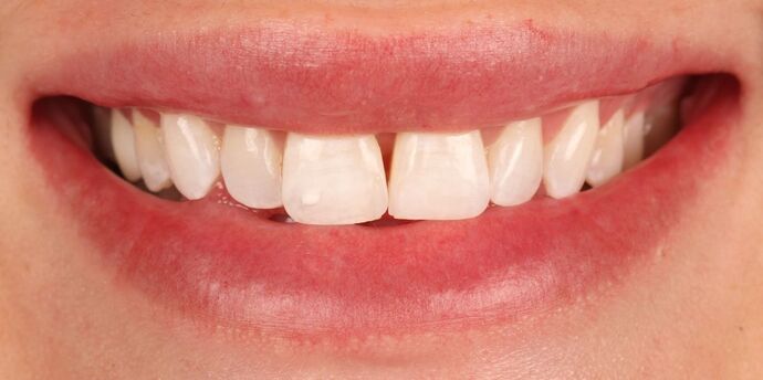 Smile Makeover: Brooke - Before