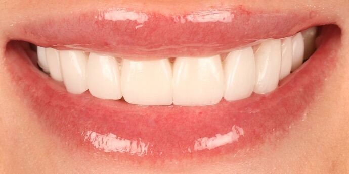 Smile Makeover: Brooke - After