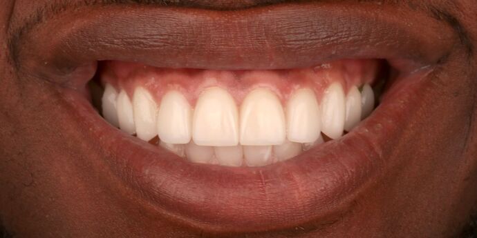 Smile Makeover: Bryce - After