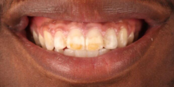 Smile Makeover: Bryce - Before