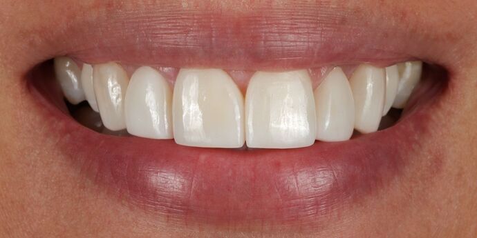 Smile Makeover: Carole - Before