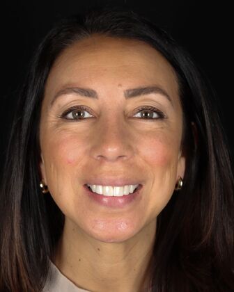 Smile Makeover Carole - Before