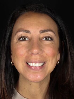 Smile Makeover Carole - Before