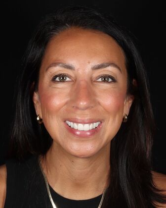 Smile Makeover Carole - After