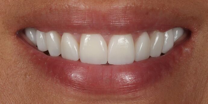 Smile Makeover: Carole - After