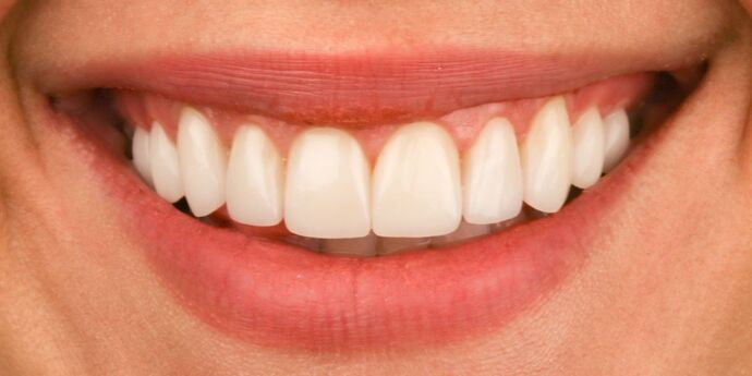 Smile Makeover: Caroline - After