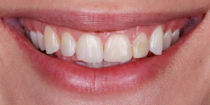 Smile Makeover: Caroline - Before