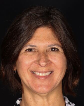 Smile Makeover Desiree - Before