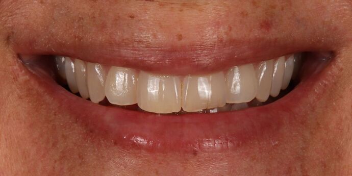 Smile Makeover: Desiree - Before