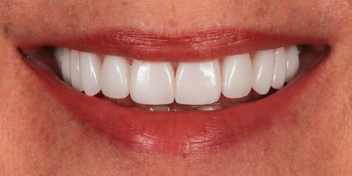 Smile Makeover: Desiree - After