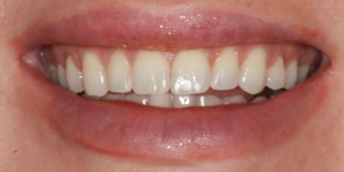 Smile Makeover: Emily - Before