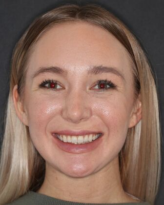 Smile Makeover Emily - Before