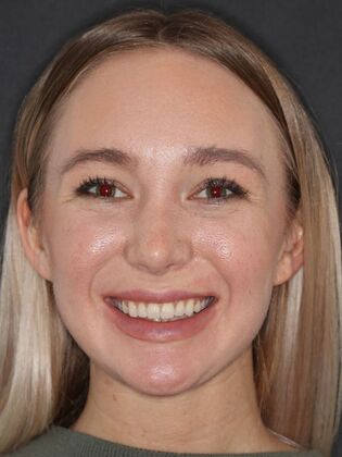 Smile Makeover Emily - Before