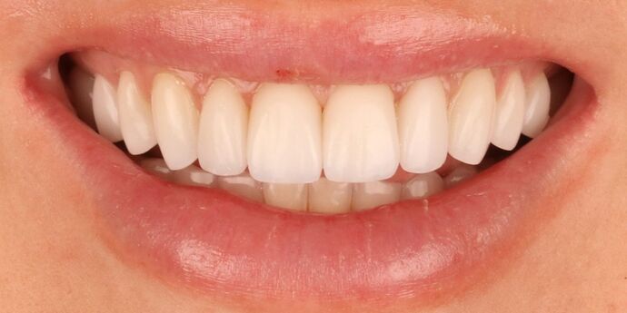 Smile Makeover: Emily - After