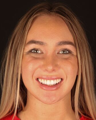 Smile Makeover Emily - After