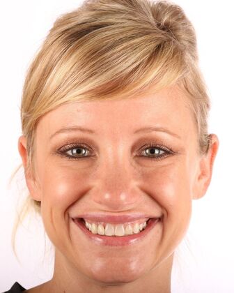 Smile Makeover Erin - Before