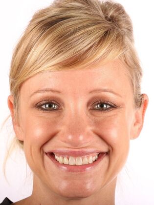 Smile Makeover Erin - Before