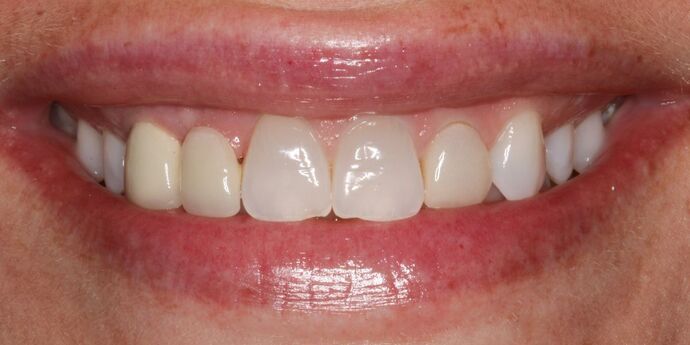 Smile Makeover: Erin - Before