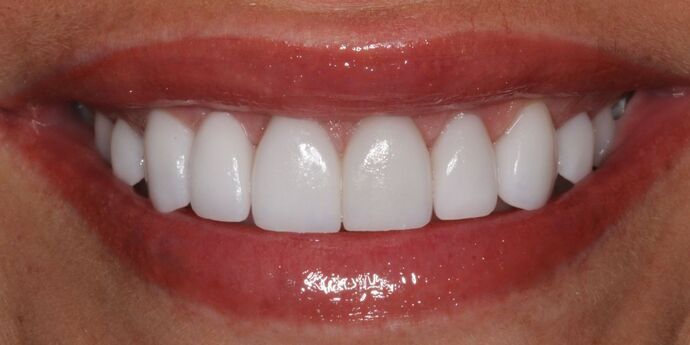 Smile Makeover: Erin - After