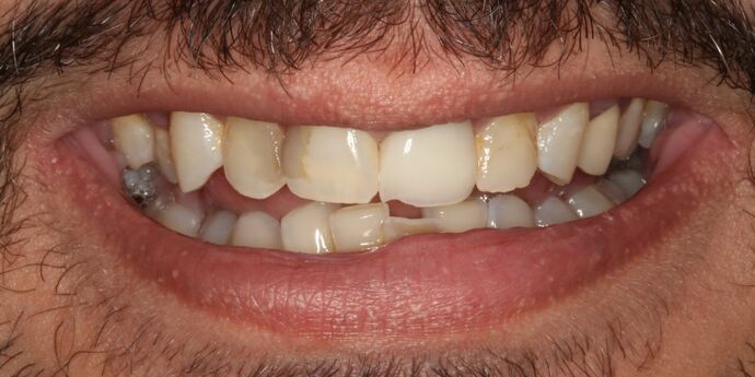 Smile Makeover: Hassan - Before