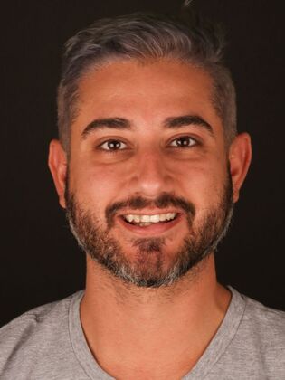 Smile Makeover Hassan - Before