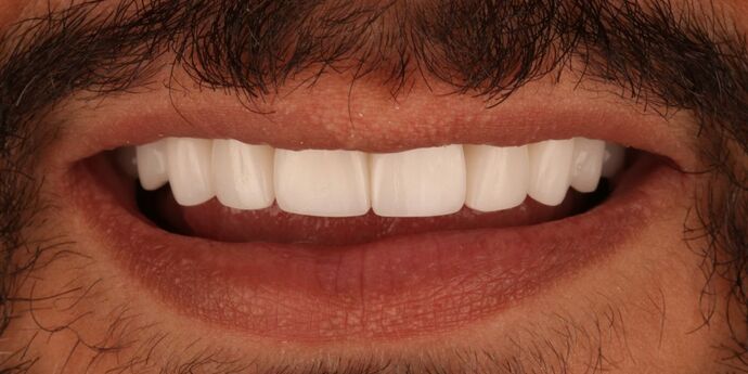 Smile Makeover: Hassan - After