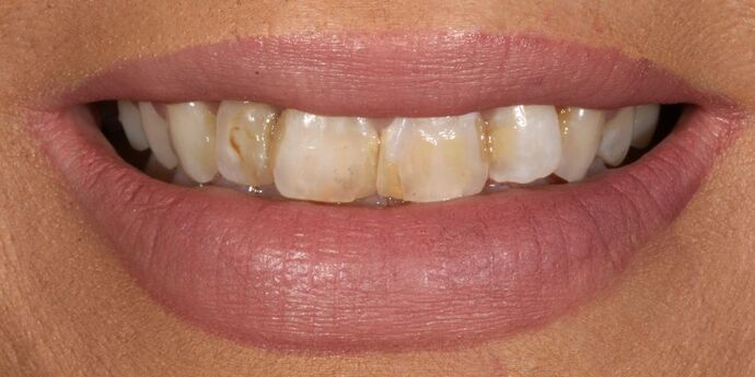 Smile Makeover: Heather - Before