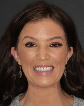 Smile Makeover Heather - After