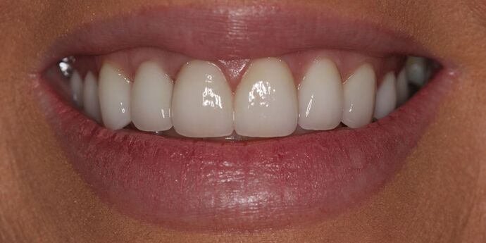 Smile Makeover: Heather - After