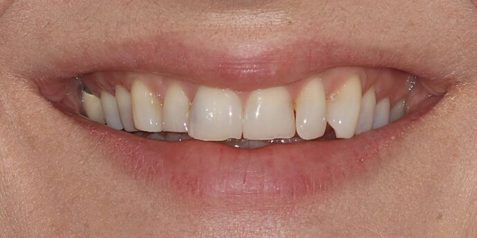 Smile Makeover: Jasmina - Before