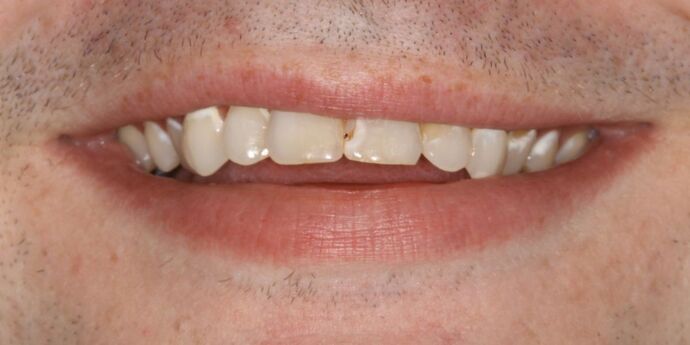 Smile Makeover: Jeff - Before