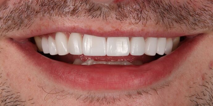 Smile Makeover: Jeff - After