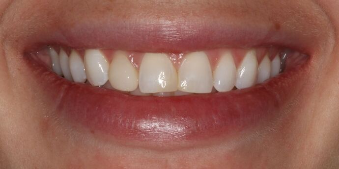 Smile Makeover: Jess - Before