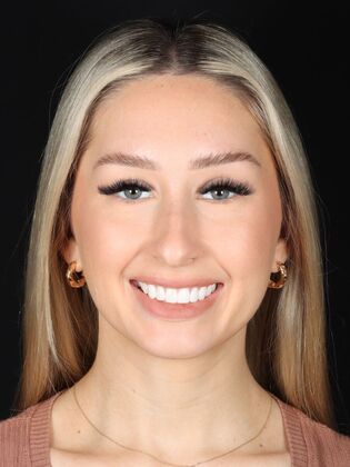 Smile Makeover Jess - After