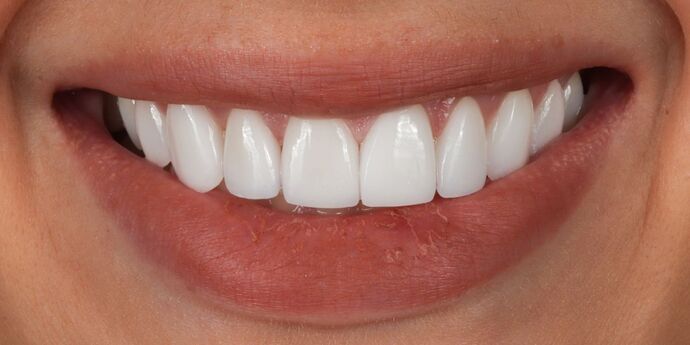 Smile Makeover: Jess - After