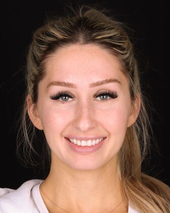 Smile Makeover Jess - Before