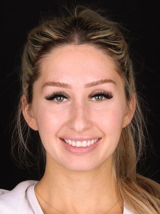 Smile Makeover Jess - Before