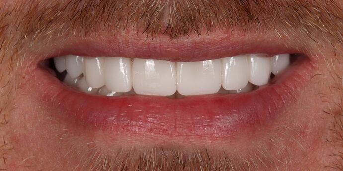 Smile Makeover: Joe - After