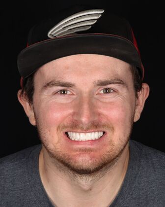 Smile Makeover Joe - After