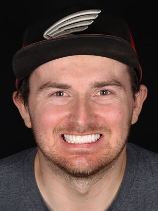 Smile Makeover Joe - After