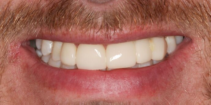 Smile Makeover: Joe - Before