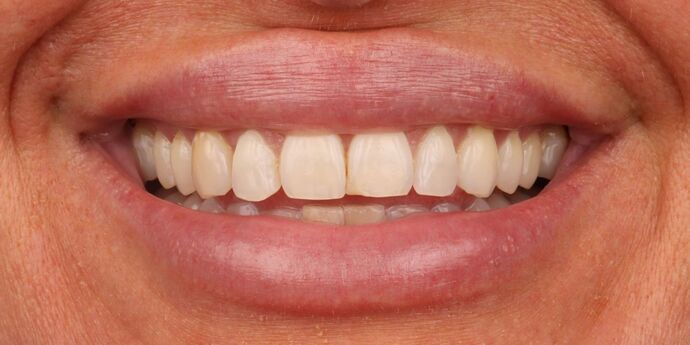 Smile Makeover: Katie - Before