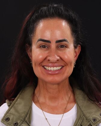 Smile Makeover Katie - Before