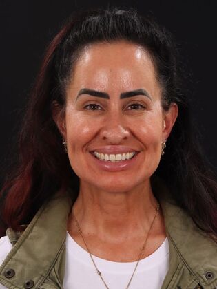 Smile Makeover Katie - Before