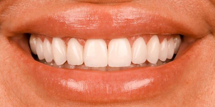 Smile Makeover: Katie - After