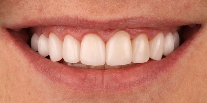 Smile Makeover: Lavonne - After